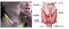 儿童患有甲状腺疾病怎么办?