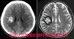 儿童血管瘤诊断很关键